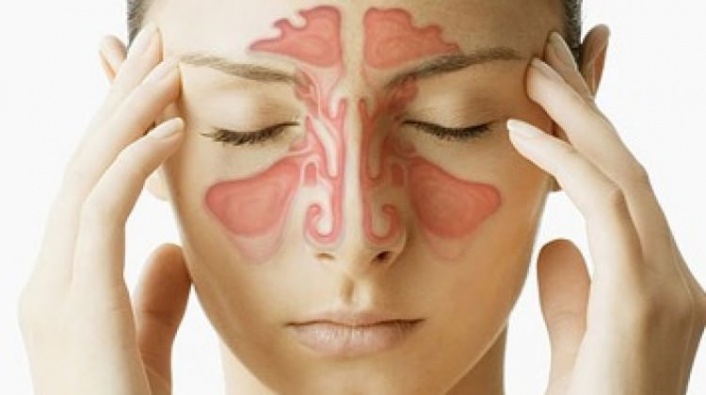 Sinüzit Nedir? Sinüzit Belirtileri Nelerdir? Sinüzit Nasıl Geçer?