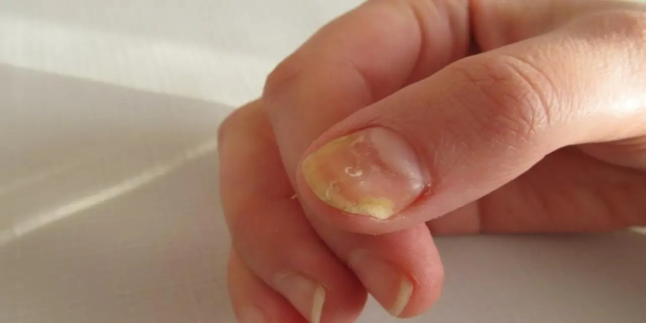 Tırnak sararması hangi vitamin eksikliğinden olur?