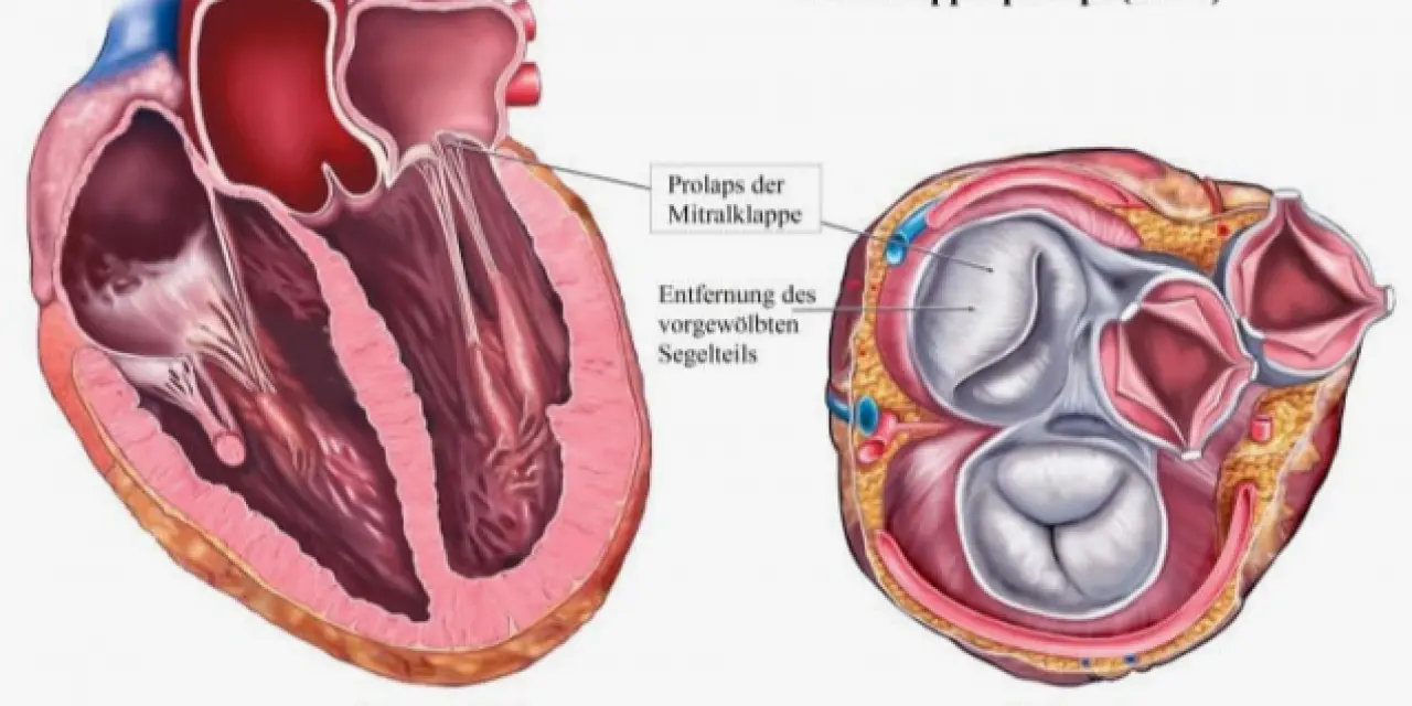 Mitral Kapak Yetmezliği: Mitral Kapak Yetmezliği Nedir?