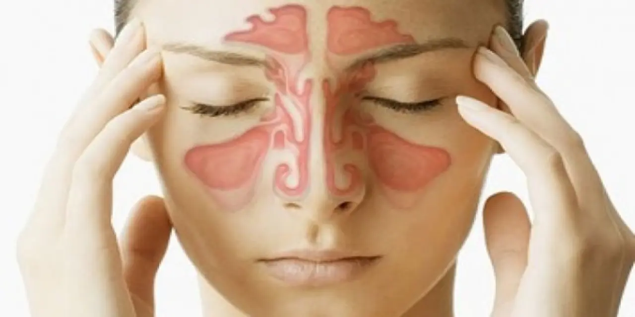 Sinüzit Nedir? Sinüzit Belirtileri Nelerdir? Sinüzit Nasıl Geçer?